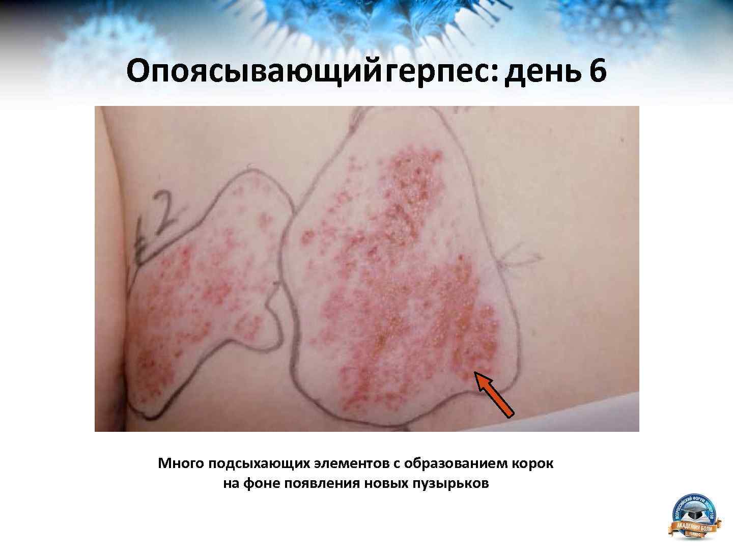 Опоясывающийгерпес: день 6 Много подсыхающих элементов с образованием корок на фоне появления новых пузырьков