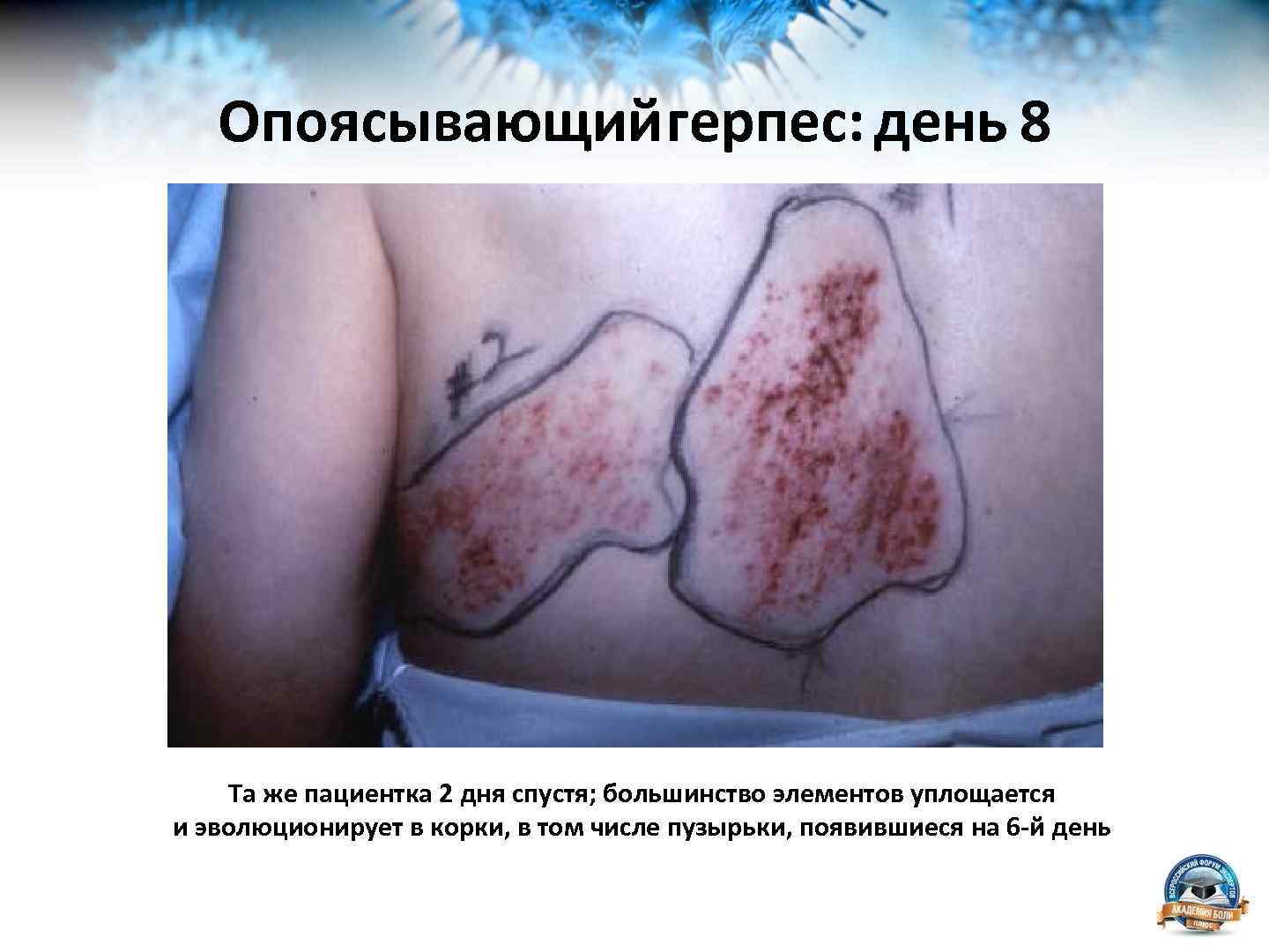 Опоясывающийгерпес: день 8 Та же пациентка 2 дня спустя; большинство элементов уплощается и эволюционирует