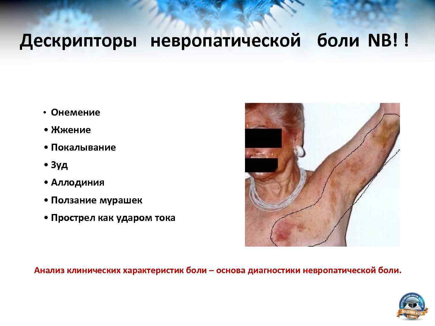 Дескрипторы невропатической боли NB! ! • Онемение • Жжение • Покалывание • Зуд •