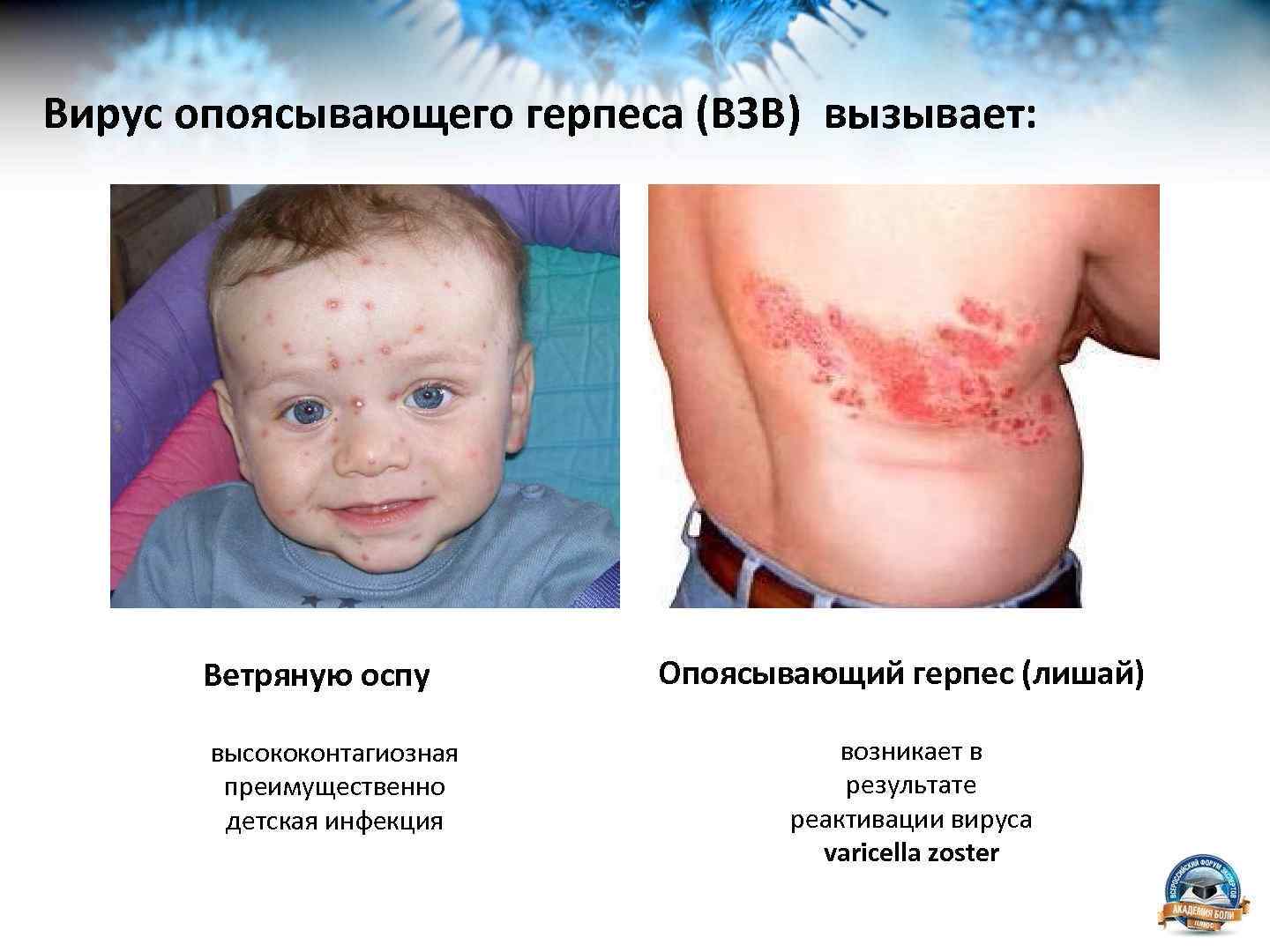 Вирус опоясывающего герпеса (ВЗВ) вызывает: Ветряную оспу высококонтагиозная преимущественно детская инфекция Опоясывающий герпес (лишай)