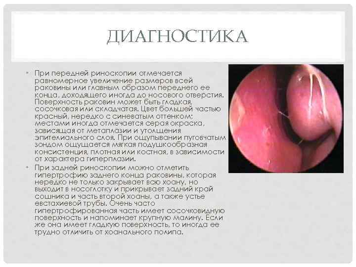 ДИАГНОСТИКА • При передней риноскопии отмечается равномерное увеличение размеров всей раковины или главным образом