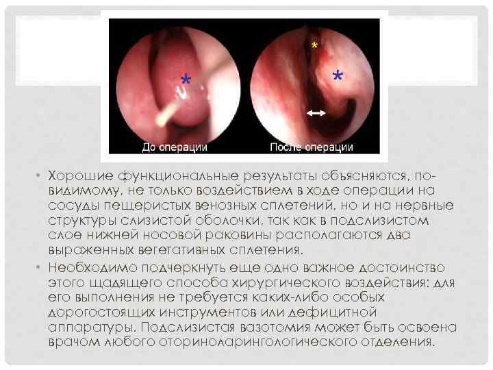  • Хорошие функциональные результаты объясняются, повидимому, не только воздействием в ходе операции на