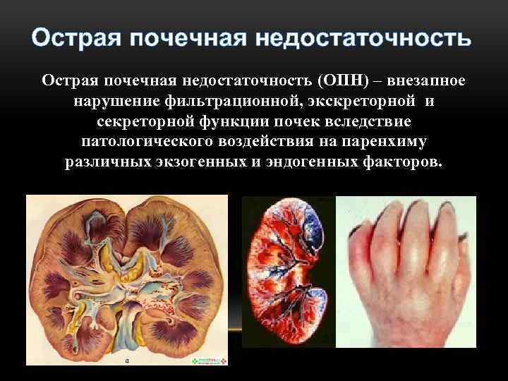 Острая почечная недостаточность (ОПН) – внезапное нарушение фильтрационной, экскреторной и секреторной функции почек вследствие