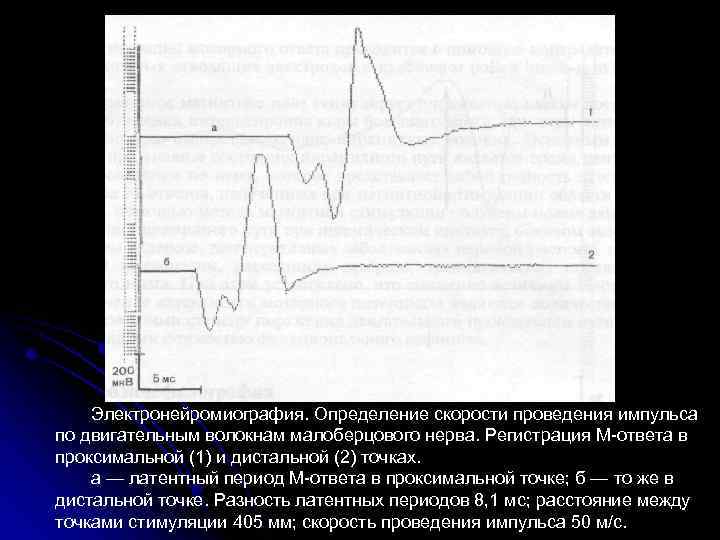 Электронейромиография. Определение скорости проведения импульса по двигательным волокнам малоберцового нерва. Регистрация М-ответа в проксимальной