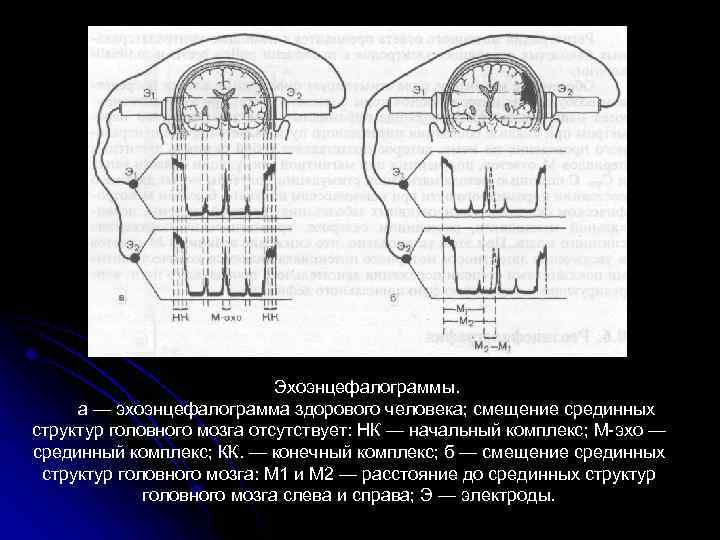 Эхоэнцефалограммы. а — эхоэнцефалограмма здорового человека; смещение срединных структур головного мозга отсутствует: НК —