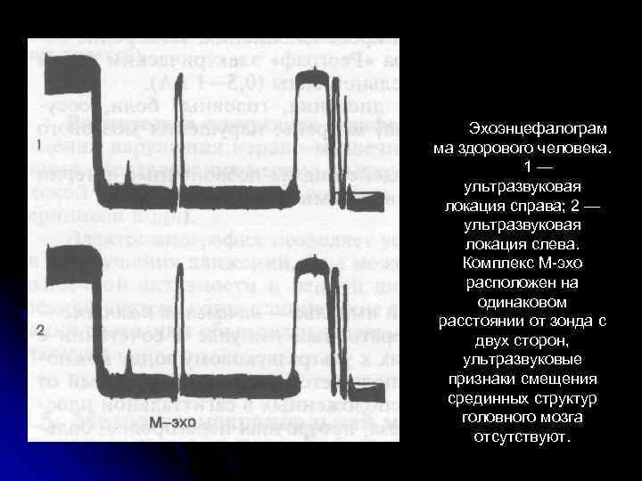 Эхоэнцефалограм ма здорового человека. 1 — ультразвуковая локация справа; 2 — ультразвуковая локация слева.