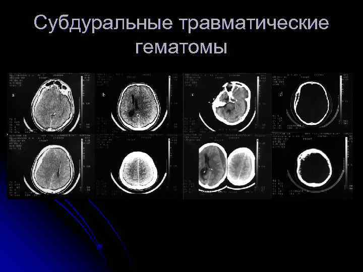 Субдуральные травматические гематомы 