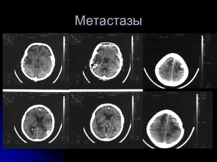 Метастазы 