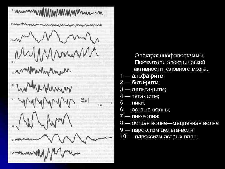 Электроэнцефалограммы. Показатели электрической активности головного мозга. 1 — альфа-ритм; 2 — бета-ритм; 3 —