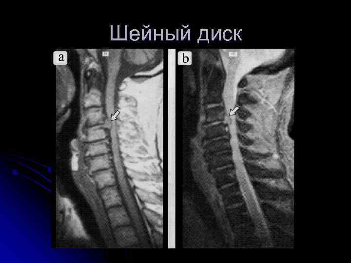 Шейный диск 
