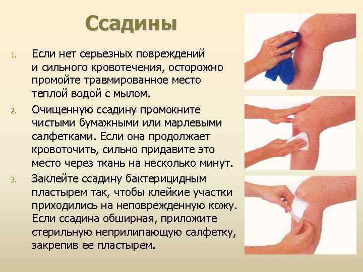 Ссадины 1. 2. 3. Если нет серьезных повреждений и сильного кровотечения, осторожно промойте травмированное