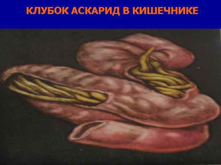 КЛУБОК АСКАРИД В КИШЕЧНИКЕ 
