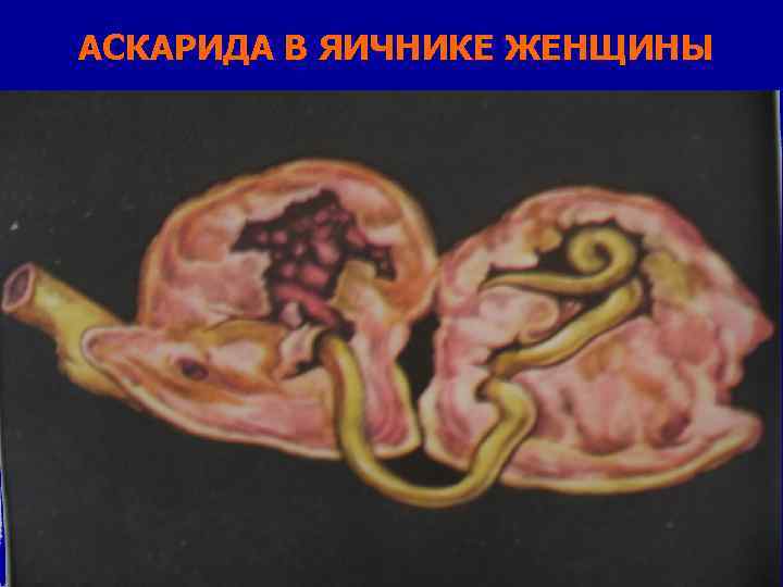 АСКАРИДА В ЯИЧНИКЕ ЖЕНЩИНЫ 