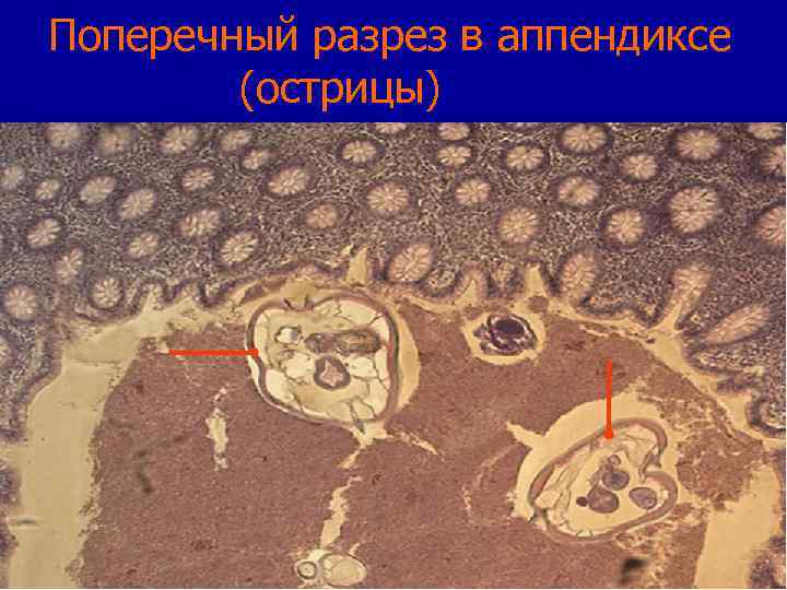 Поперечный разрез в аппендиксе (острицы) 