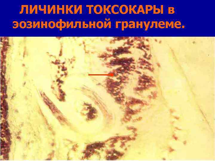 ЛИЧИНКИ ТОКСОКАРЫ в эозинофильной гранулеме. 