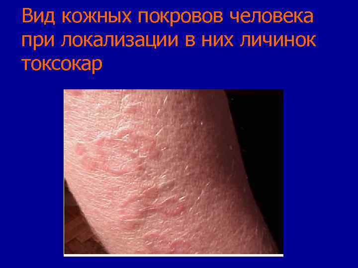 Вид кожных покровов человека при локализации в них личинок токсокар 