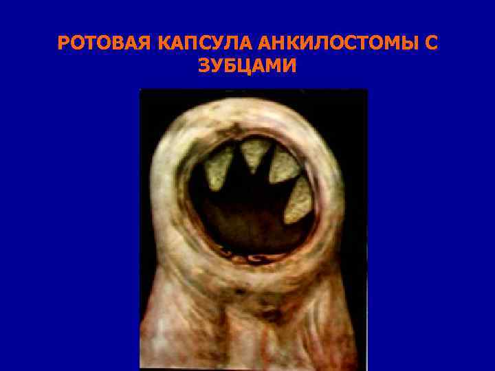 РОТОВАЯ КАПСУЛА АНКИЛОСТОМЫ С ЗУБЦАМИ 