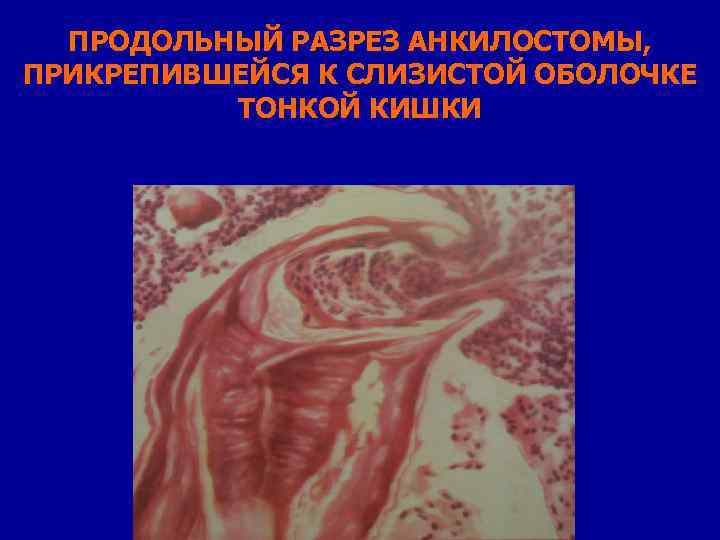 ПРОДОЛЬНЫЙ РАЗРЕЗ АНКИЛОСТОМЫ, ПРИКРЕПИВШЕЙСЯ К СЛИЗИСТОЙ ОБОЛОЧКЕ ТОНКОЙ КИШКИ 