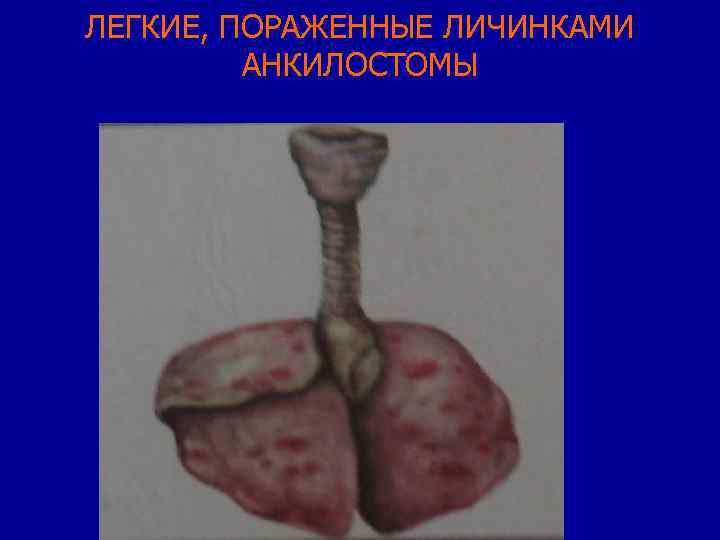 ЛЕГКИЕ, ПОРАЖЕННЫЕ ЛИЧИНКАМИ АНКИЛОСТОМЫ 