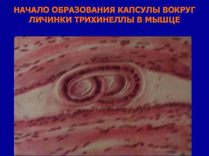 НАЧАЛО ОБРАЗОВАНИЯ КАПСУЛЫ ВОКРУГ ЛИЧИНКИ ТРИХИНЕЛЛЫ В МЫШЦЕ 