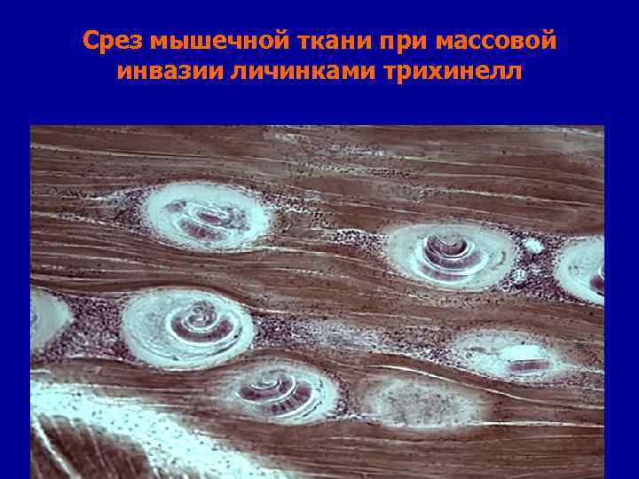 Срез мышечной ткани при массовой инвазии личинками трихинелл 
