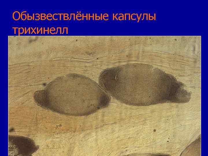 Обызвествлённые капсулы трихинелл 