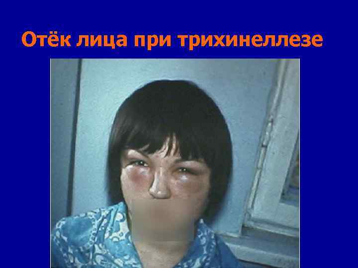 Отёк лица при трихинеллезе 