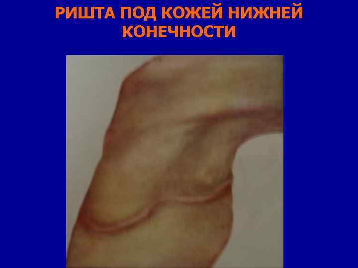 РИШТА ПОД КОЖЕЙ НИЖНЕЙ КОНЕЧНОСТИ 