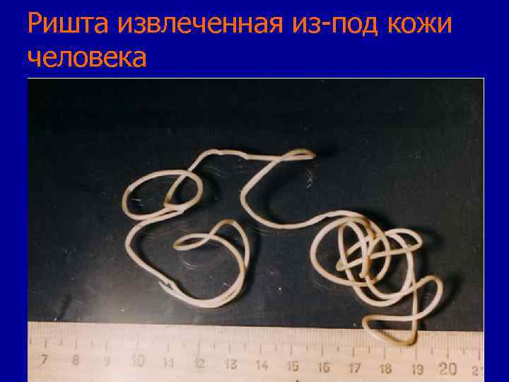 Ришта извлеченная из-под кожи человека 