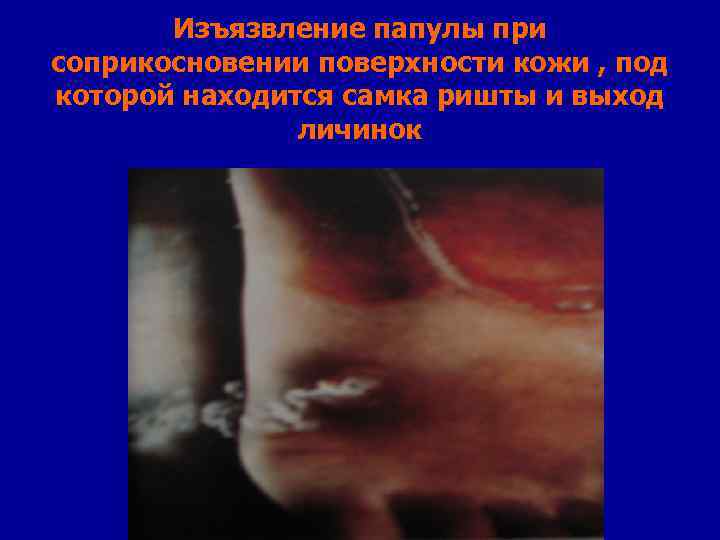 Изъязвление папулы при соприкосновении поверхности кожи , под которой находится самка ришты и выход