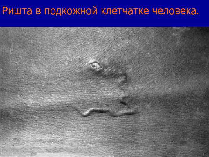 Ришта в подкожной клетчатке человека. 