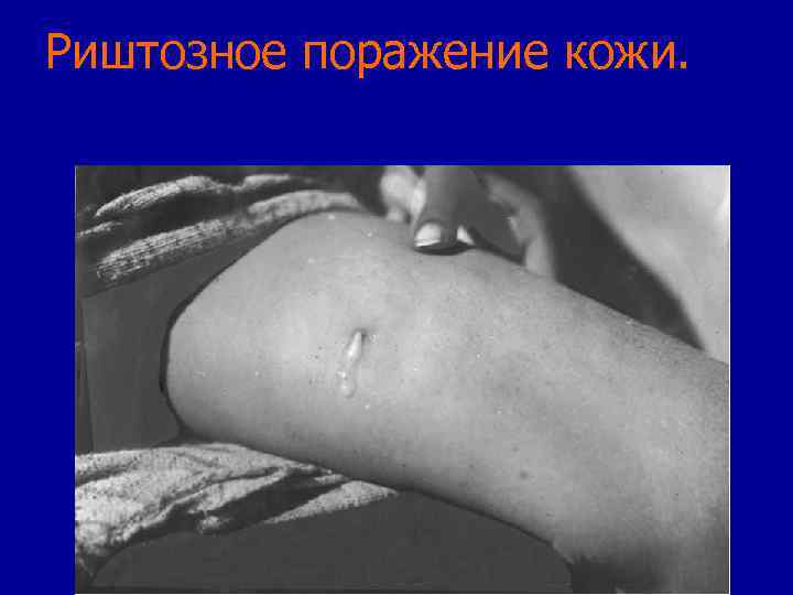 Риштозное поражение кожи. 