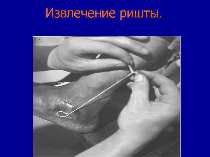 Извлечение ришты. 