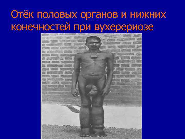 Отёк половых органов и нижних конечностей при вухерериозе 