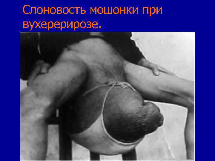 Слоновость мошонки при вухерерирозе. 