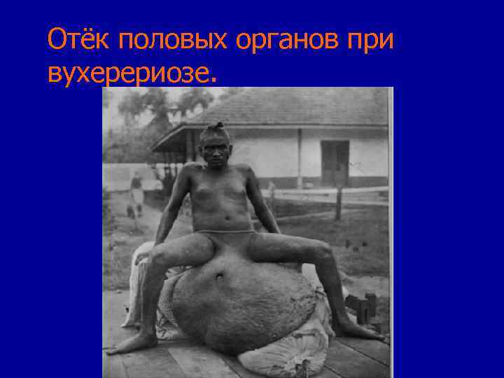 Отёк половых органов при вухерериозе. 