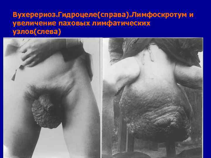 Вухерериоз. Гидроцеле(справа). Лимфоскротум и увеличение паховых лимфатических узлов(слева) 