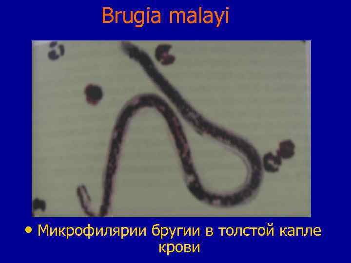 Brugia malayi • Микрофилярии бругии в толстой капле крови 