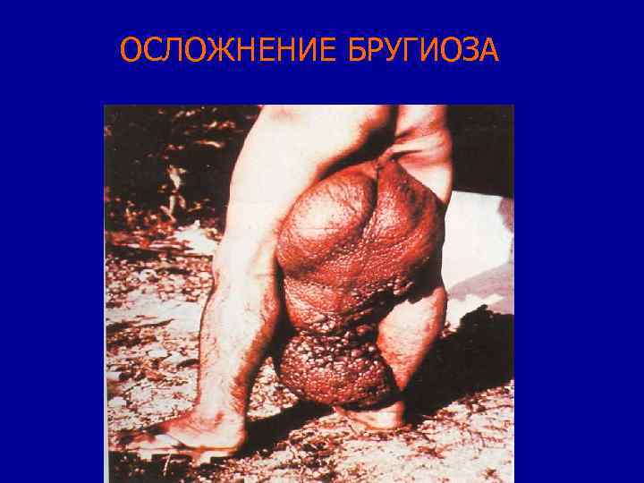 ОСЛОЖНЕНИЕ БРУГИОЗА 