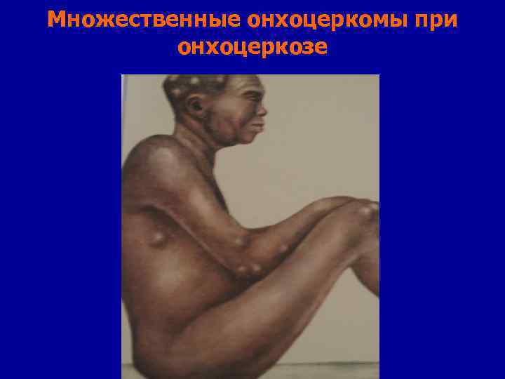 Множественные онхоцеркомы при онхоцеркозе 