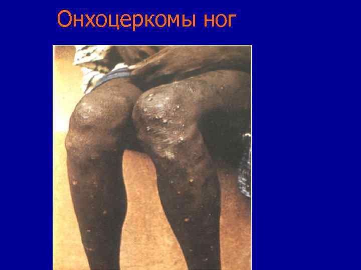 Онхоцеркомы ног 