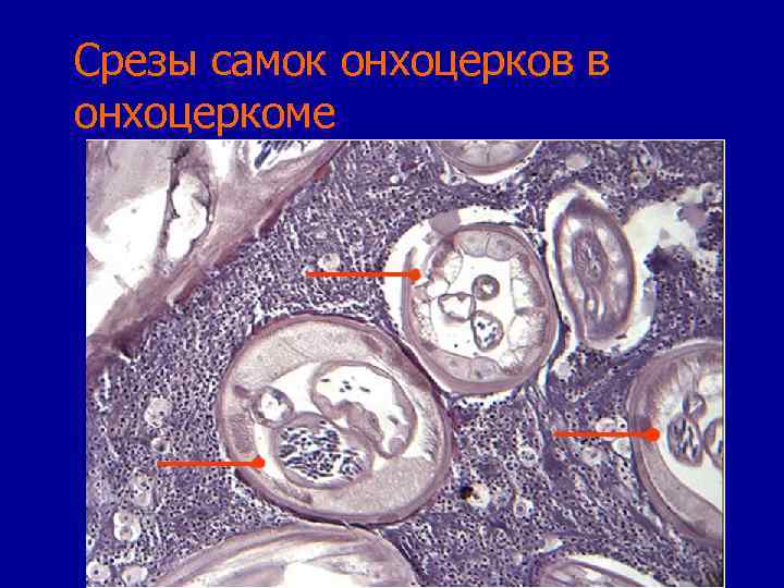 Срезы самок онхоцерков в онхоцеркоме 