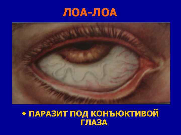 ЛОА-ЛОА • ПАРАЗИТ ПОД КОНЪЮКТИВОЙ ГЛАЗА 