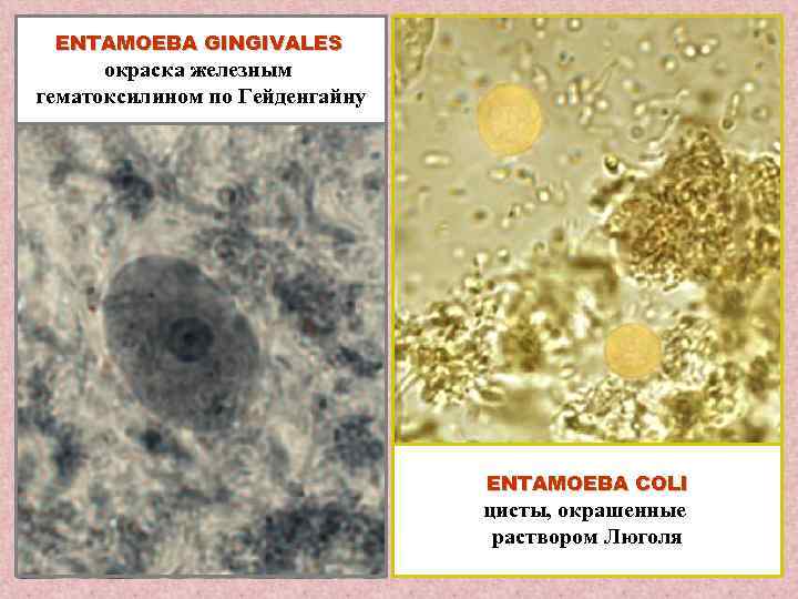 ENTAMOEBA GINGIVALES окраска железным гематоксилином по Гейденгайну ENTAMOEBA COLI цисты, окрашенные раствором Люголя 
