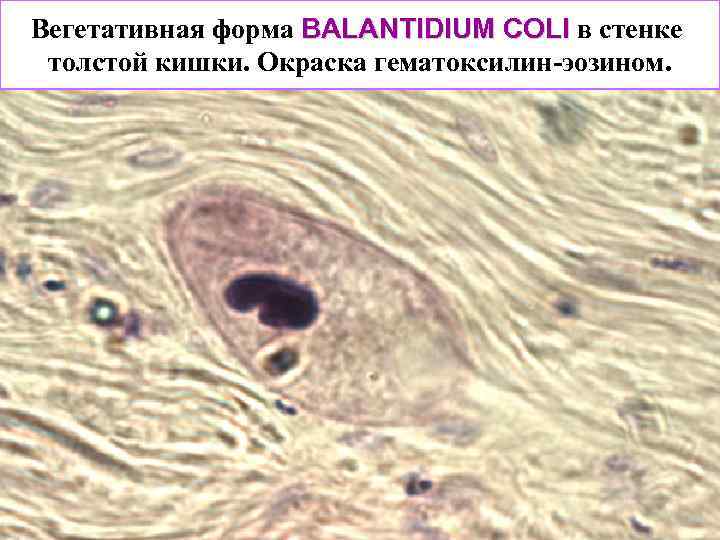 Вегетативная форма BALANTIDIUM COLI в стенке толстой кишки. Окраска гематоксилин-эозином. 
