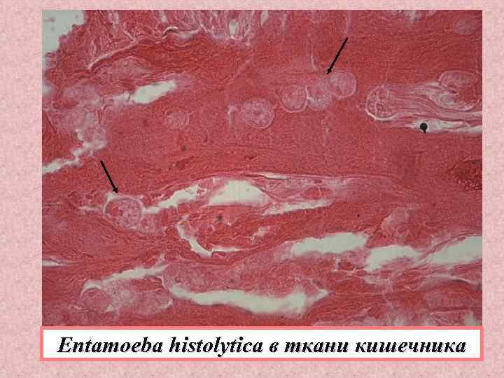 Entamoeba histolytica в ткани кишечника 