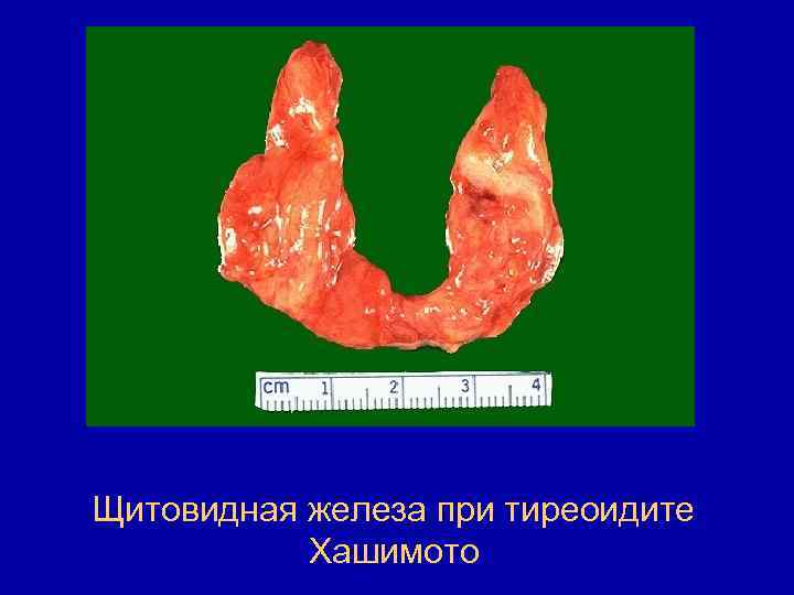 Щитовидная железа при тиреоидите Хашимото 
