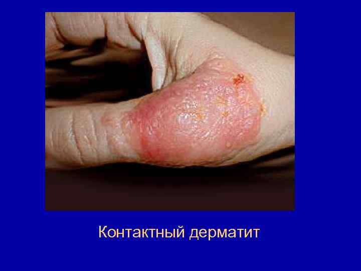 Контактный дерматит 