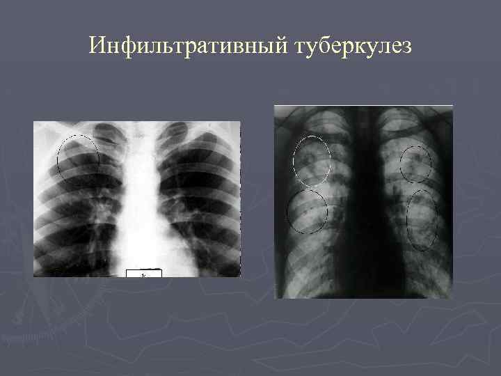 Инфильтративный легкого в фазе распада. Инфильтративный туберкулез рентген. Инфильтративный туберкулез легких рентген. Инфильтративный туберкулёз лёгких рентген. Инфильтративный туберкулез Лобит рентген.