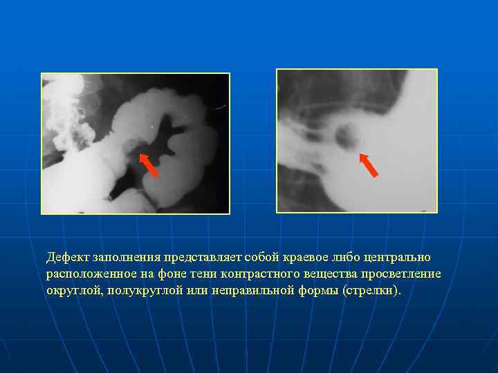 Дефект заполнения представляет собой краевое либо центрально расположенное на фоне тени контрастного вещества просветление